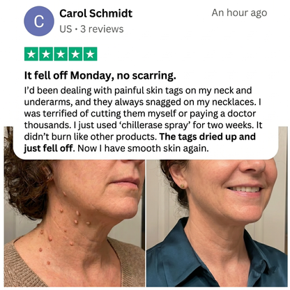 ChillErase® Bump Renewal Spray